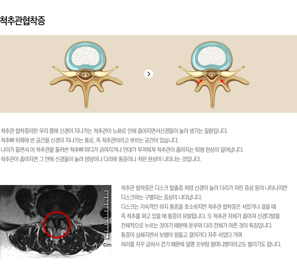 척추관협착증