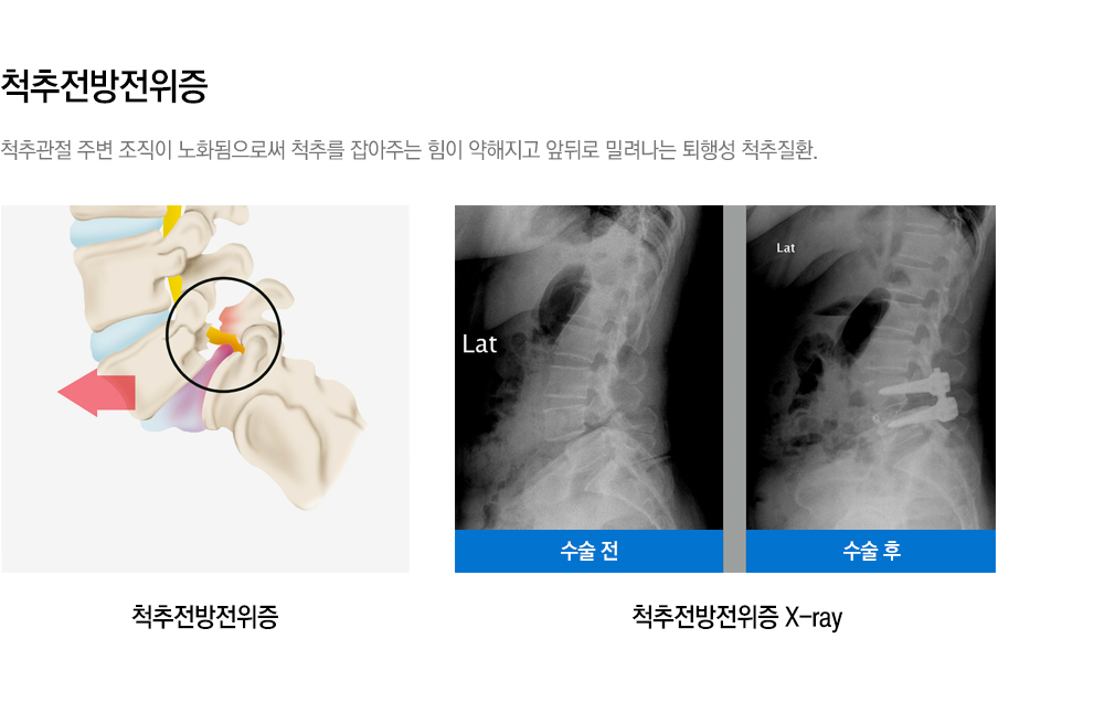 내시경 치료 가능한 척추질환